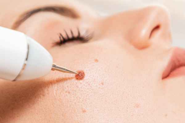 CryoPen: 5 Skin Concerns It May Be Used to Treat 3 What actually happens during a CryoPen treatment Portland Bill?