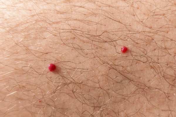 CryoPen: 5 Skin Concerns It May Be Used to Treat 2 cherry angioma removal Portland Bill