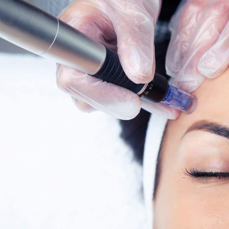 Morpheus8 treatment Portland Bill from Lipo Sculpt - Book in today!